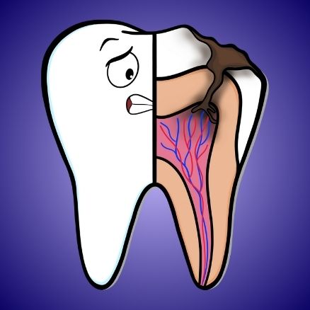 Dente Devitalizzato Endodonzia Microscopica
