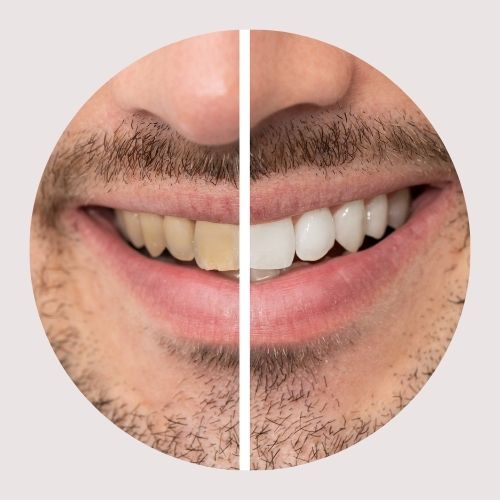 SBIANCAMENTO DENTALE