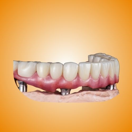 protesi dentali Lecce