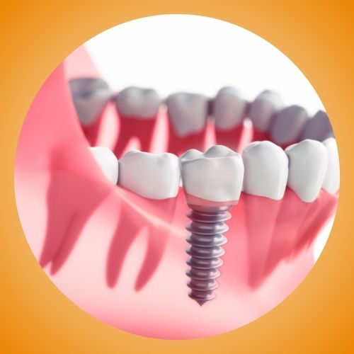 implantologia mini invasiva Lecce